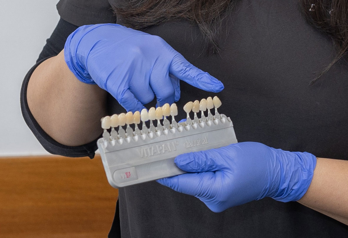 Dental Veneers