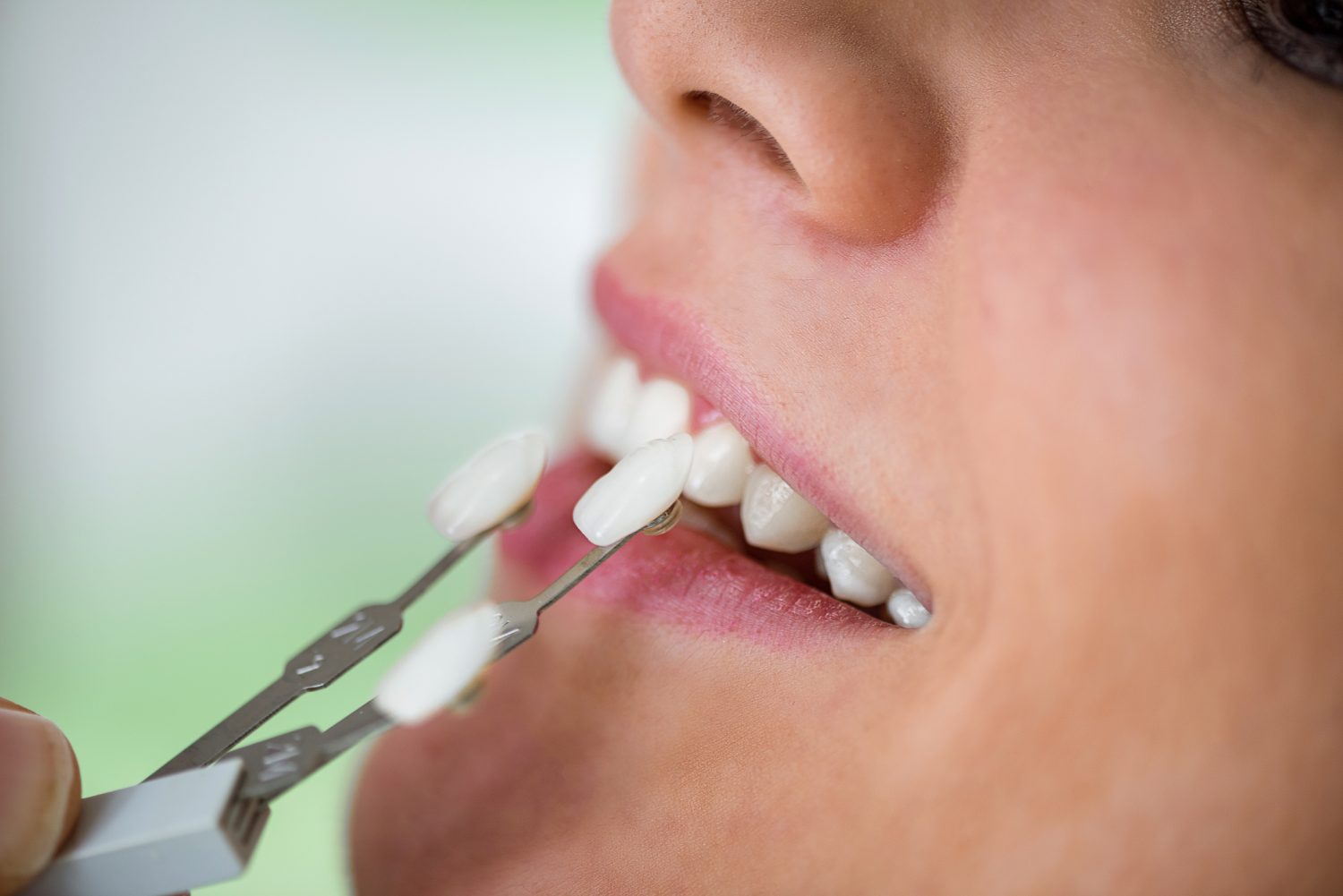 Dental Veneers