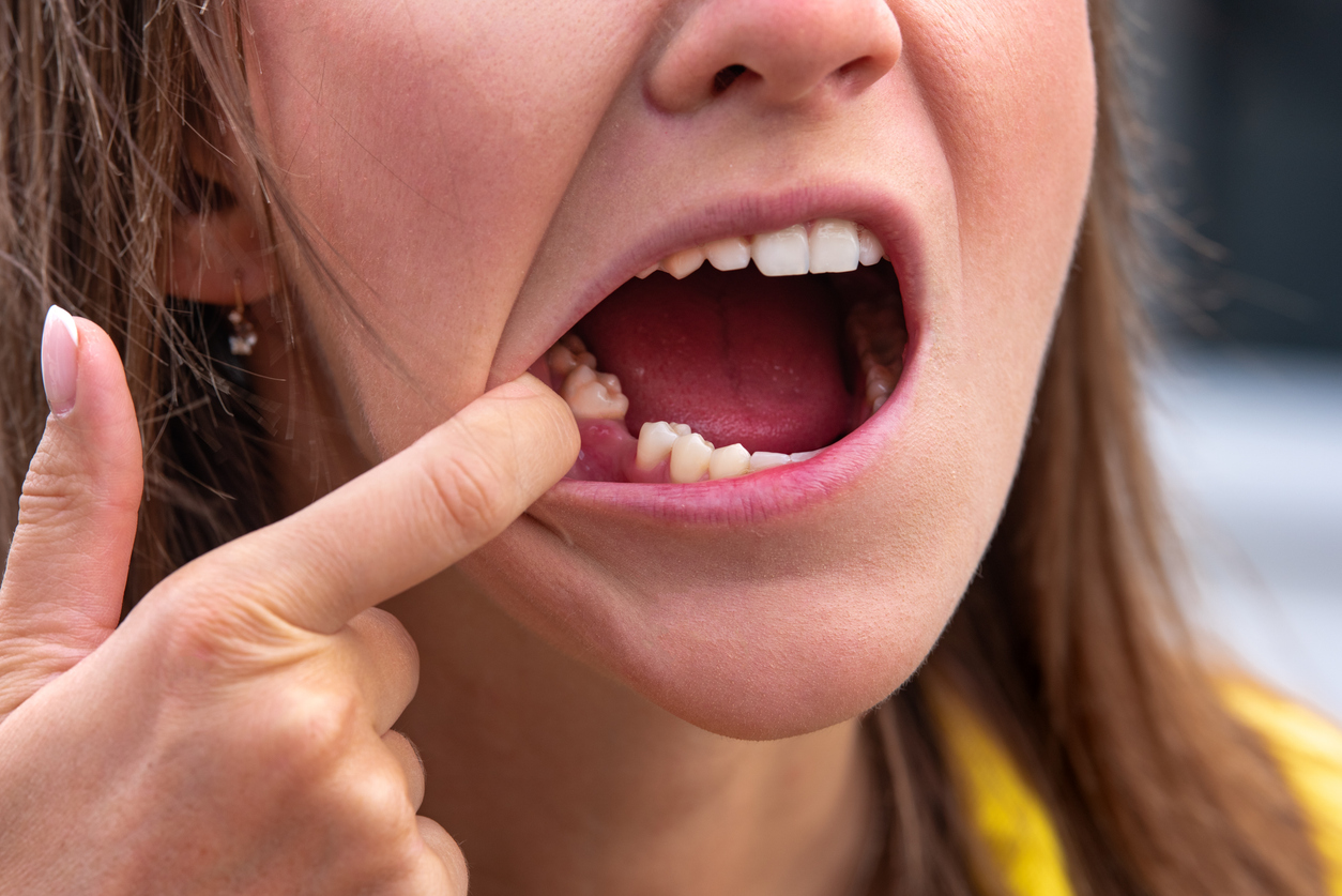 Dental Bridges