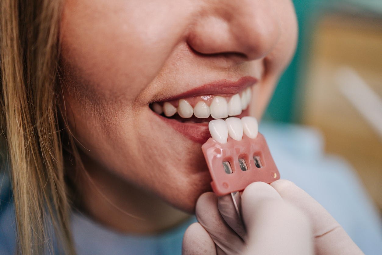 Invisalign Clear Aligners