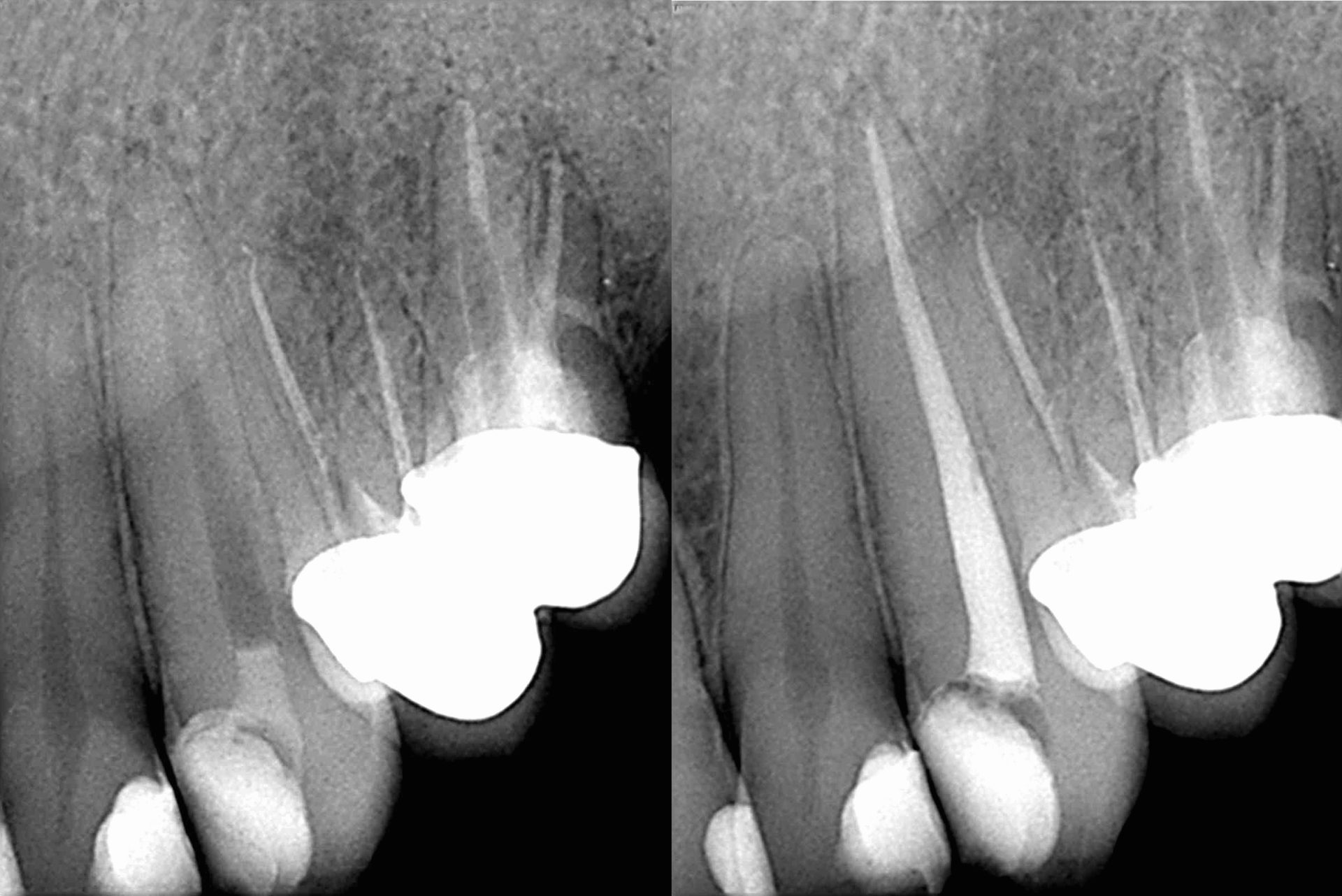 Root Canal Treatment