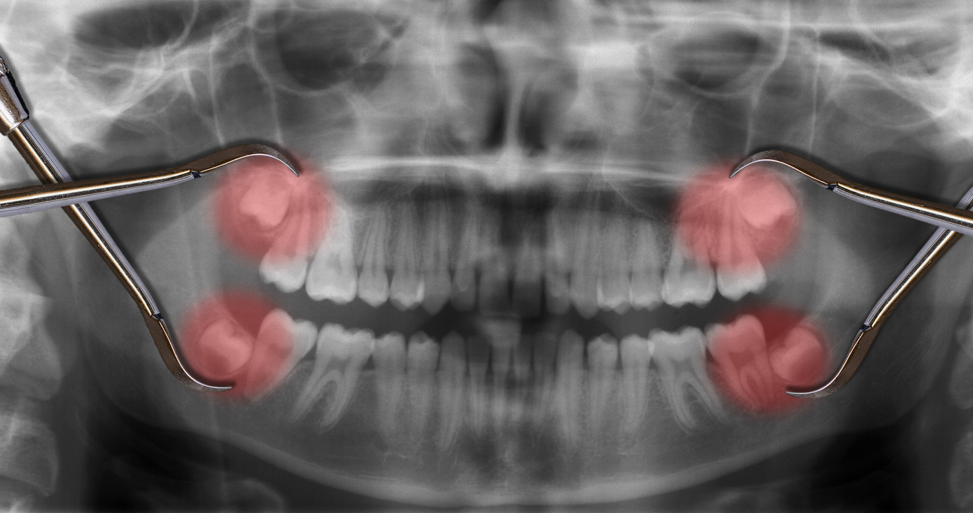 Extractions