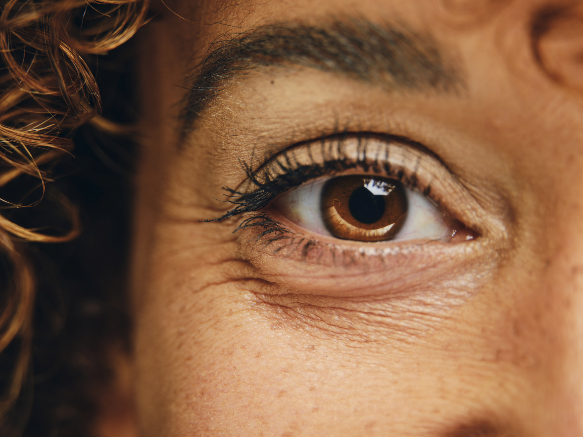 Plinest<sup>&reg;</sup> Under-Eye Rejuvenation